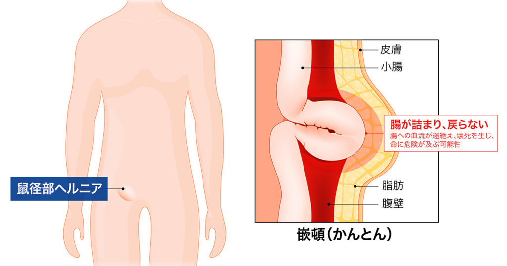 鼠径部ヘルニア（脱腸）とは？原因や種類、症状を解説