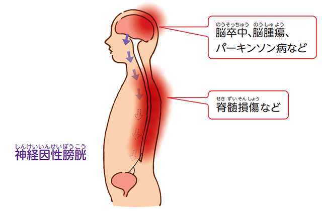 膀胱炎って?療養・予防のポイントは? | みんなのクリニック大井町