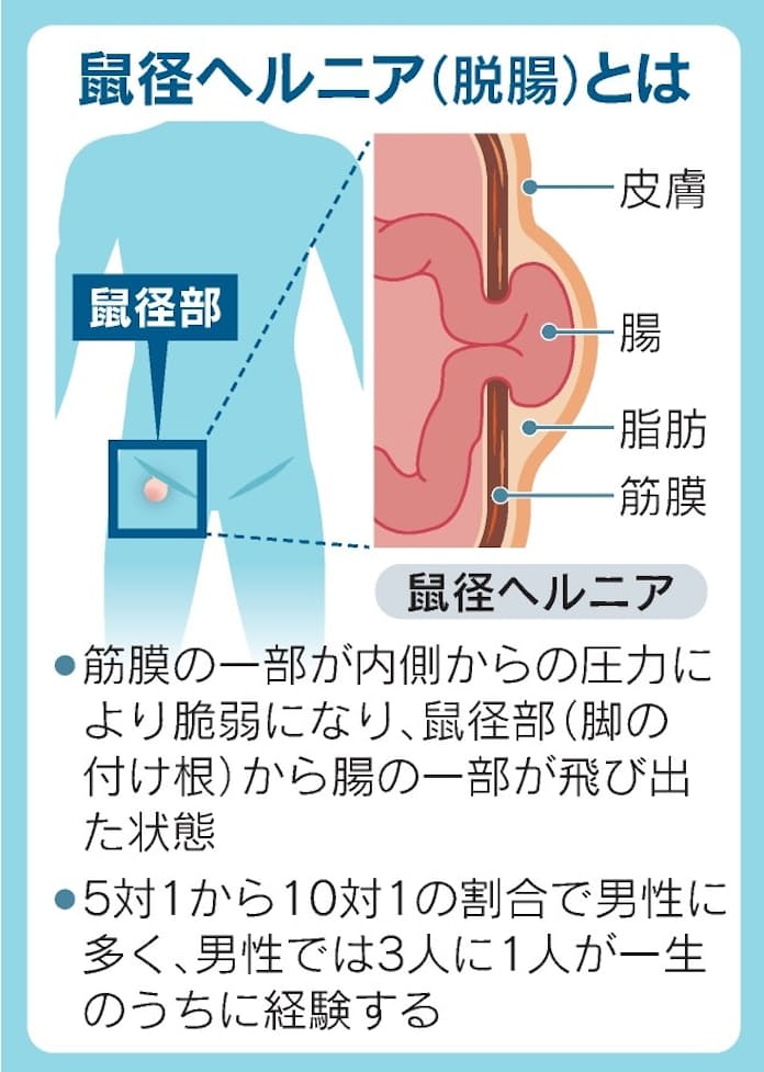 鼠径ヘルニア｜腹部ヘルニア｜四谷メディカルキューブ