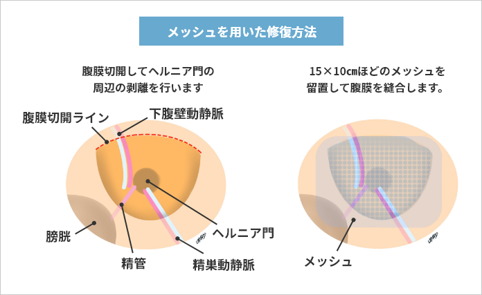 鼠径ヘルニア修復：手術の選択肢｜ブログ｜Gi外科クリニック