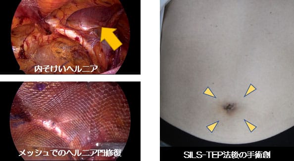 グロインペイン症候群（鼠径部痛症候群） | 奈良体幹パーソナルトレーニングジム