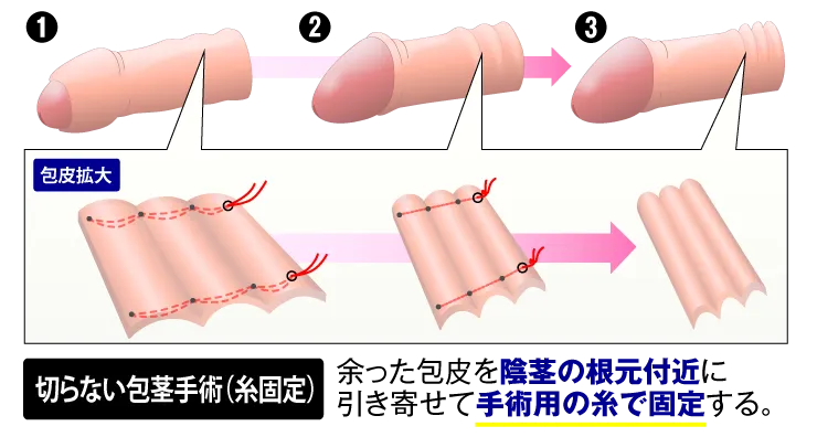 包茎手術ならネオ形成外科へ | ネオ形成外科