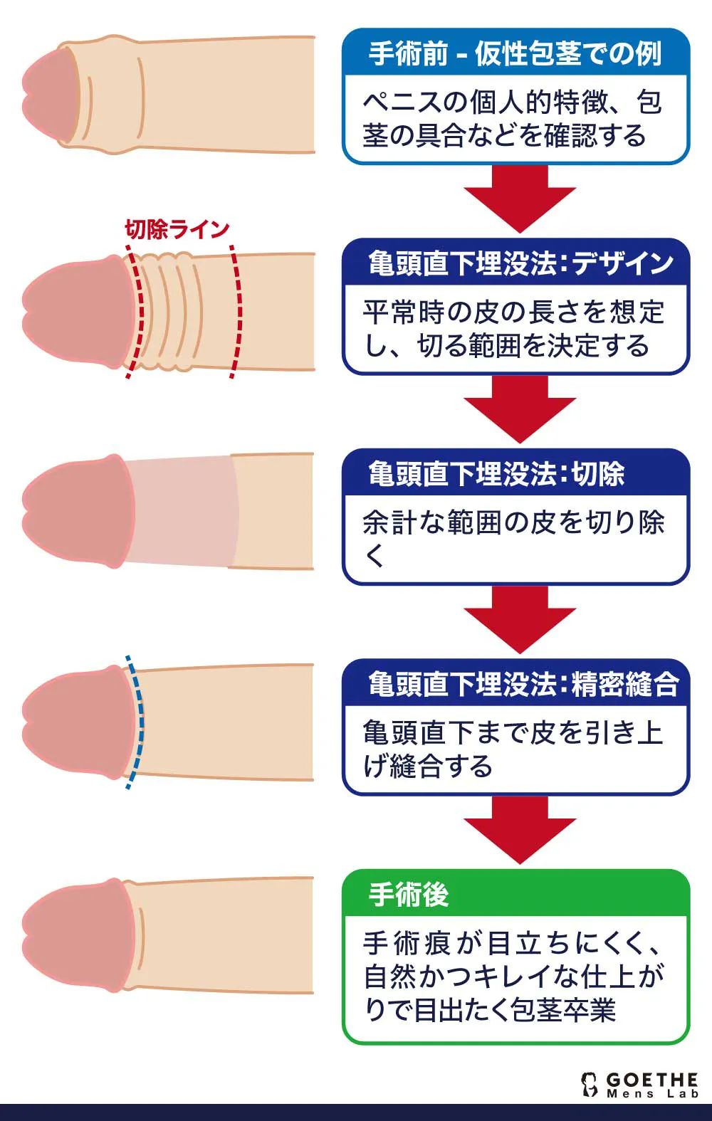 アトムクリニックの口コミ・評判まとめ！切らない包茎手術や長径術の料金と施術方法を調査 | 包茎治療について｜おき泌尿器科クリニック｜富田林市の泌尿器科