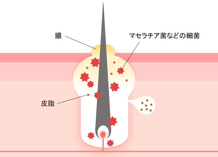 毛穴専門スキンケア💐コーくん先生 | 【知らないと損】アソコ10秒温めるとニキビエグい消える