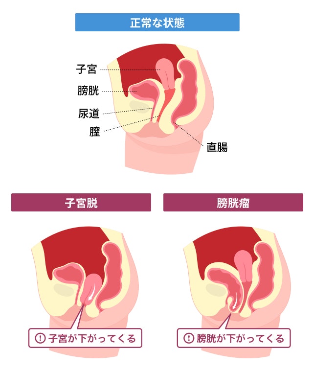 骨盤臓器脱で、悩んでいませんか？ | PICK UP |