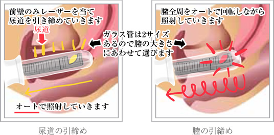 分娩に伴う処置 | 看護roo![カンゴルー]