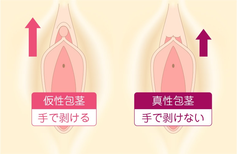 クリトリス包茎だと感じづらい？皮の剥き方 - 夜の保健室