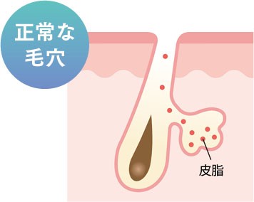 毛嚢炎(毛包炎)の原因と治し方 - 医療脱毛専門クレアクリニック