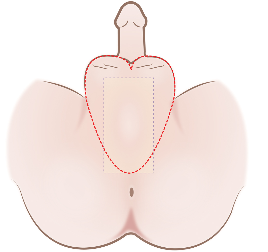 ガモン病院のMtF（外性器のみ造形-造膣無し）手術 - タイSRS 性別適合手術