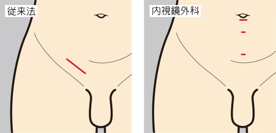 岡山市南区・中区で グロインペイン症候群（鼠径部痛症候群） でお悩みなら陽だまり鍼灸整骨院へ｜岡山市南区クチコミ1位