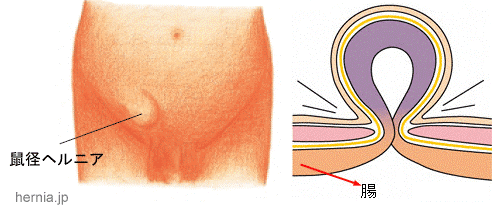 鼠径部痛症候群（グロインペイン症候群） ｜SPORTS MEDICINE LIBRARY｜ザムスト（ZAMST）