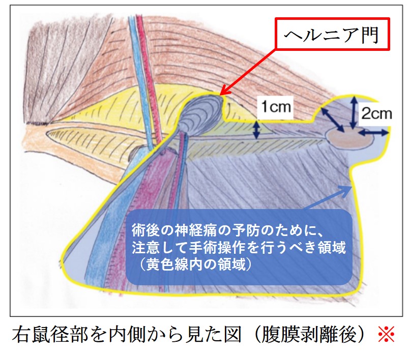 鼠径ヘルニアを放置すると | 鼠径ヘルニア日帰り外科広島アルプスクリニック