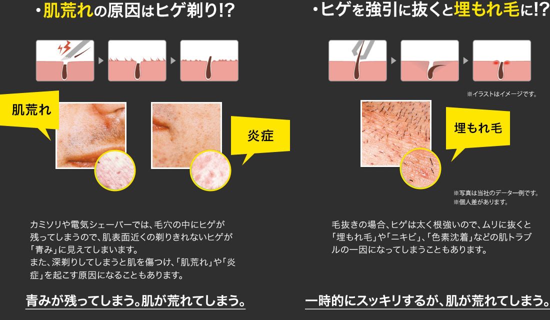 ピンセット 毛抜き 髭抜き とげ抜き ムダ毛処理