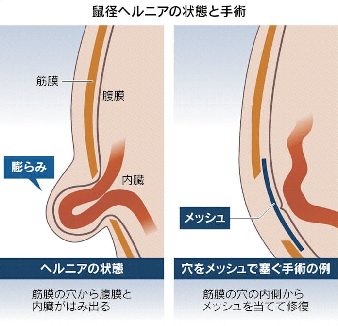 鼠径部の痛み・腫れ - 横浜みなと外科クリニック