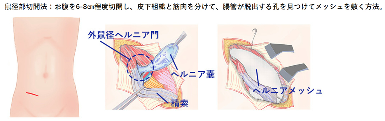 鼠径ヘルニアについて ｜那覇市の内視鏡外科・消化器内科、肛門外科｜友寄クリニック｜胃カメラ・大腸検査