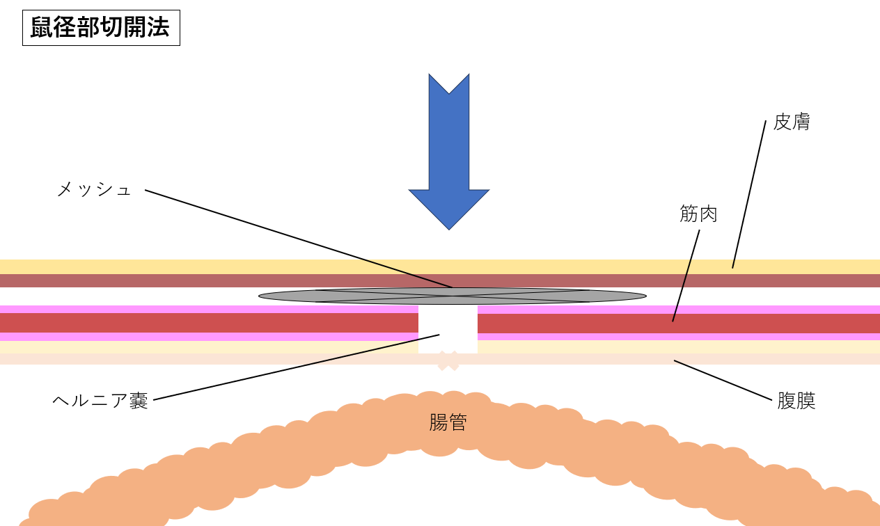 代表的な手術例 鼠径ヘルニア -