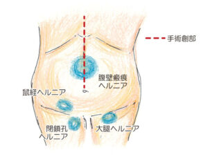 グロインペイン症候群】鼠径部や股関節の痛みなら鍼灸を | 【ゆうこん堂鍼灸院】広島市・安芸郡海田町のはりきゅう専門