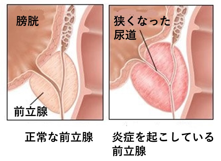 前立腺肥大症 | ～笑顔でスッキリ～