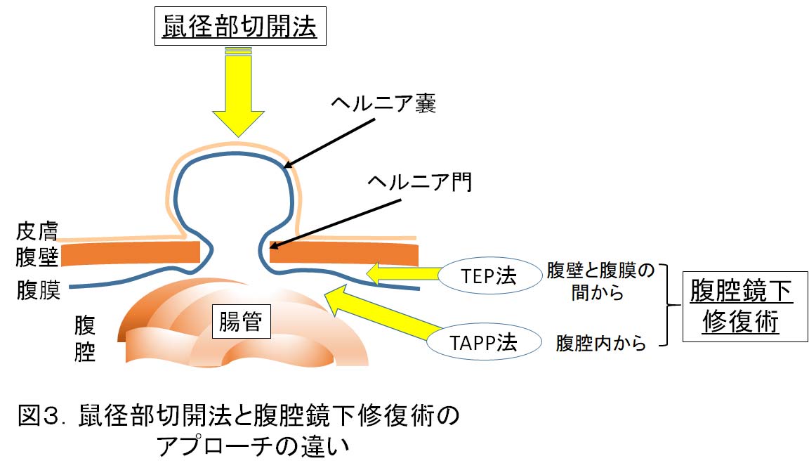 鼠径ヘルニア | 倉敷市 チクバ外科・胃腸科・肛門科病院