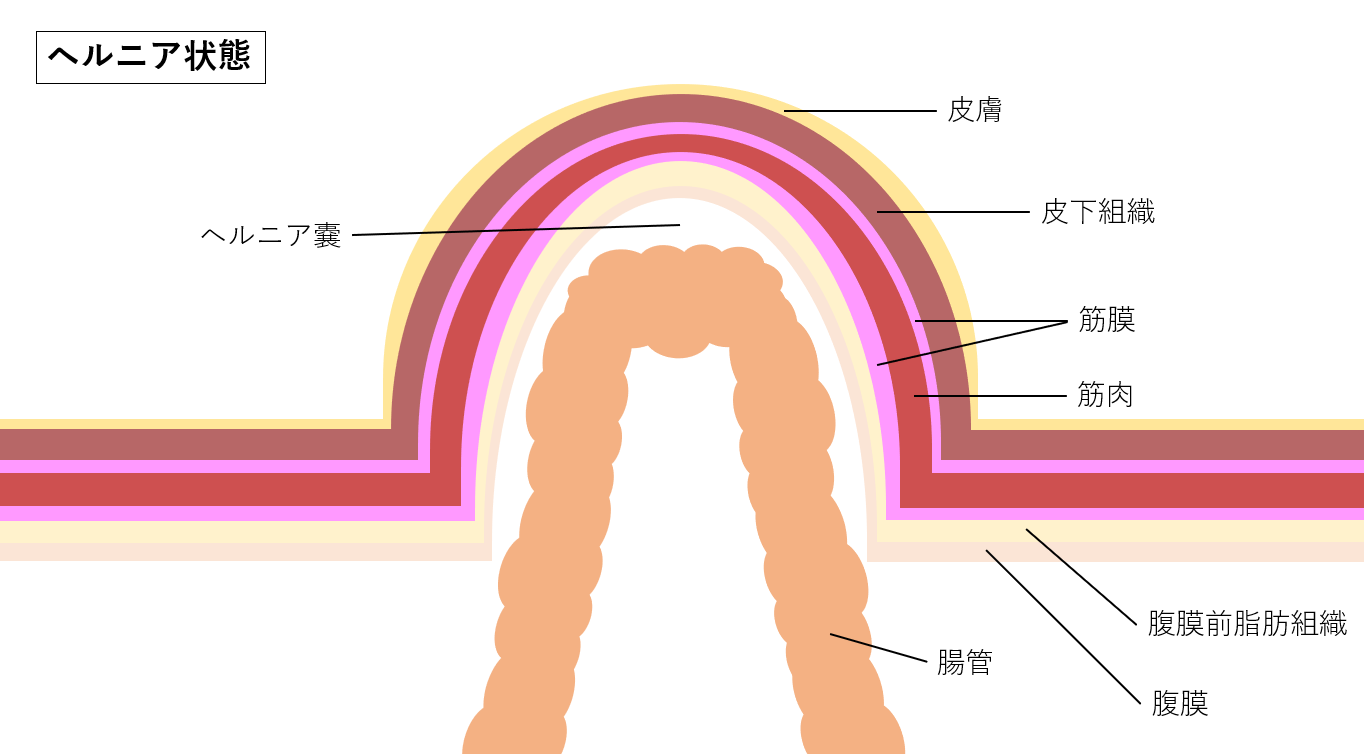 鼠径ヘルニア | 倉敷市 チクバ外科・胃腸科・肛門科病院