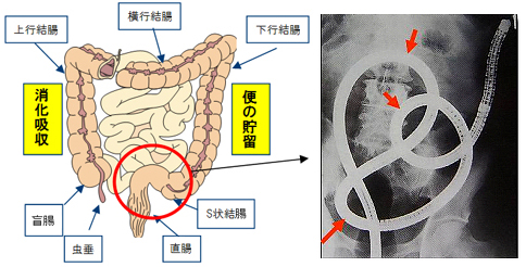 大腸がん | 山口大学大学院医学系研究科