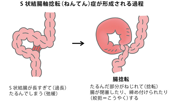 大腸がん（結腸がん・直腸がん） 治療：[国立がん研究センター がん情報サービス 一般の方へ]