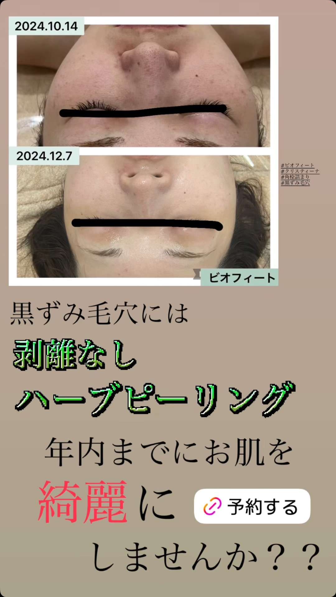 小顔、丸顔、エラやたるみ、ほうれい線、二重アゴが気になる方は骨格小顔デザインでくっきりフェイスラインへ改善！兵庫県（尼崎エステ）Rinda  Beauty