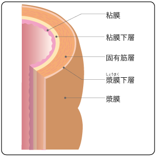 大腸憩室症 (だいちょうけいしつしょう)とは | 済生会