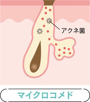 アソコが硬いとニキビできます… | しょうた@スキンケアおたくが投稿したフォトブック