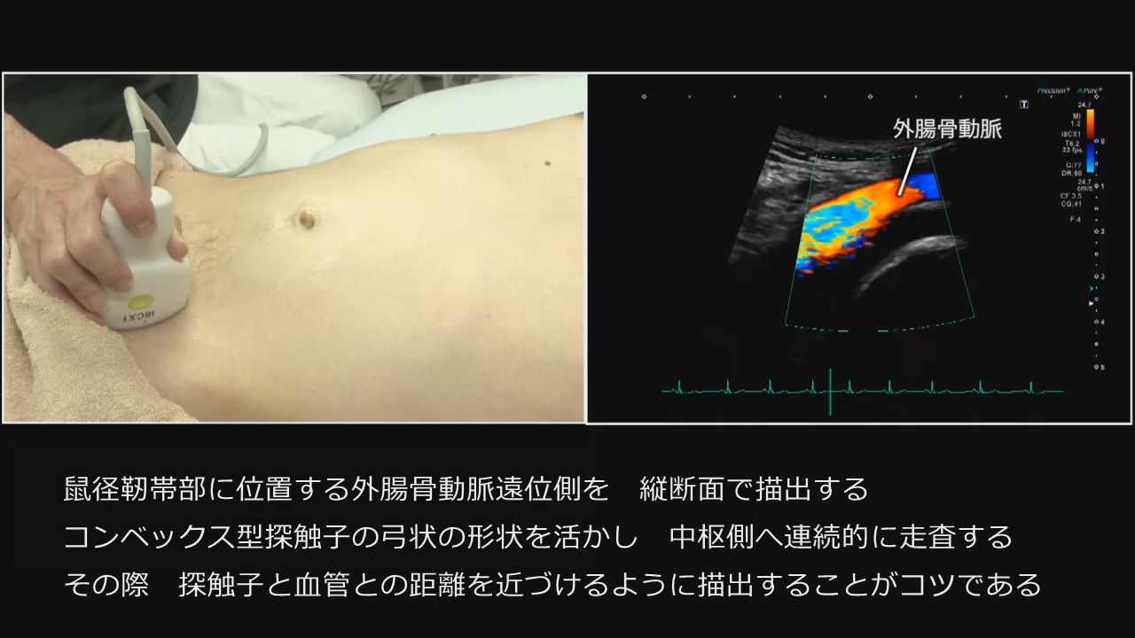 グロインペイン症候群（鼠径部痛症候群） - 埼玉県上尾市、さいたま市北区｜すぎやま整骨院