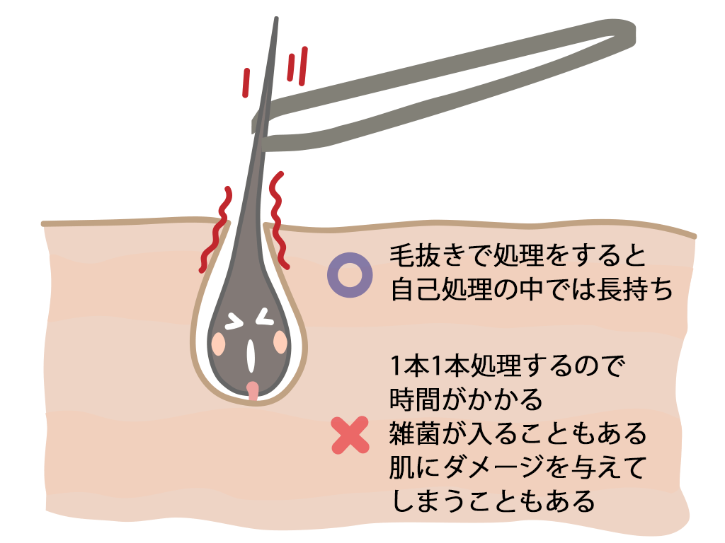 埋没毛ってこんな感じの髭です⁉️ | 業界初24時間営業メンズ専門️‍♂️美容電気脱毛(ニードル)と光脱毛サロン