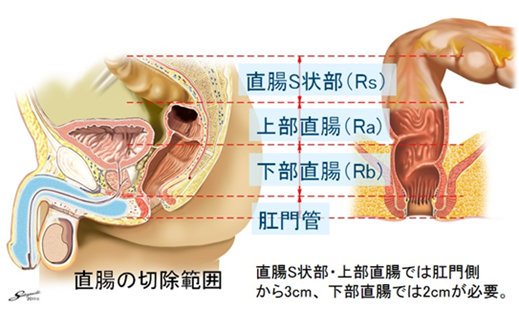 大腸がんの最新治療法 | 神戸市垂水区／消化器(胃・大腸)／内視鏡検査、腹腔鏡手術、抗がん剤治療は佐野病院