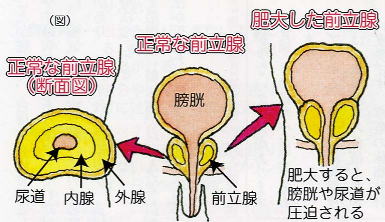前立腺肥大症｜原因｜症状｜治療法｜排尿障害｜頻尿