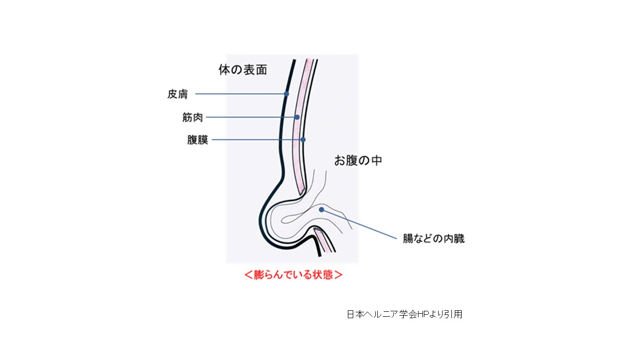 鼠径ヘルニアとは - 東京の鼠径ヘルニア日帰り手術専門│調布駅前そけいヘルニアクリニック【公式】