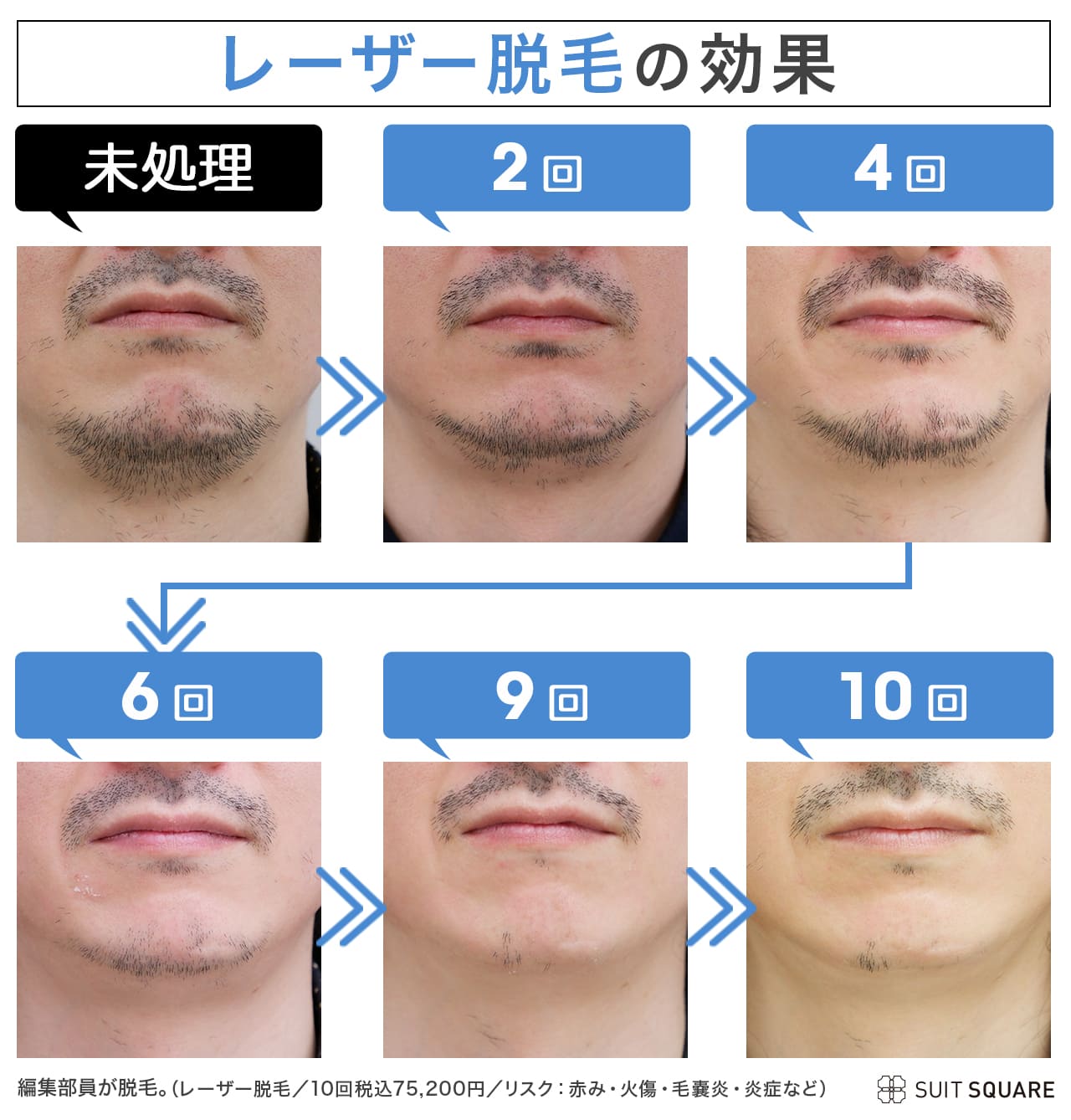 メンズの首脱毛の効果を解説｜首の脱毛をするメリットやより効果を実感する方法・施術の痛み・費用相場もご紹介します | 今泉スキンクリニック