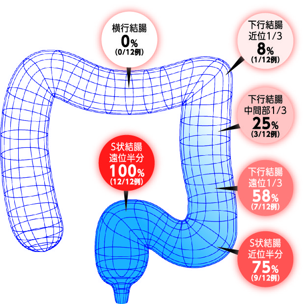 画像あり】S状結腸軸捻転とは？原因、症状、CT、治療まとめ！