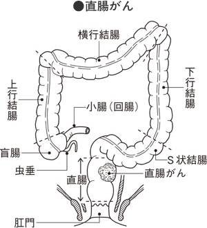 S状結腸軸捻転症｜オリンパス おなかの健康ドットコム