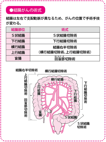 大腸がん | 見のがすな！がんのサイン |